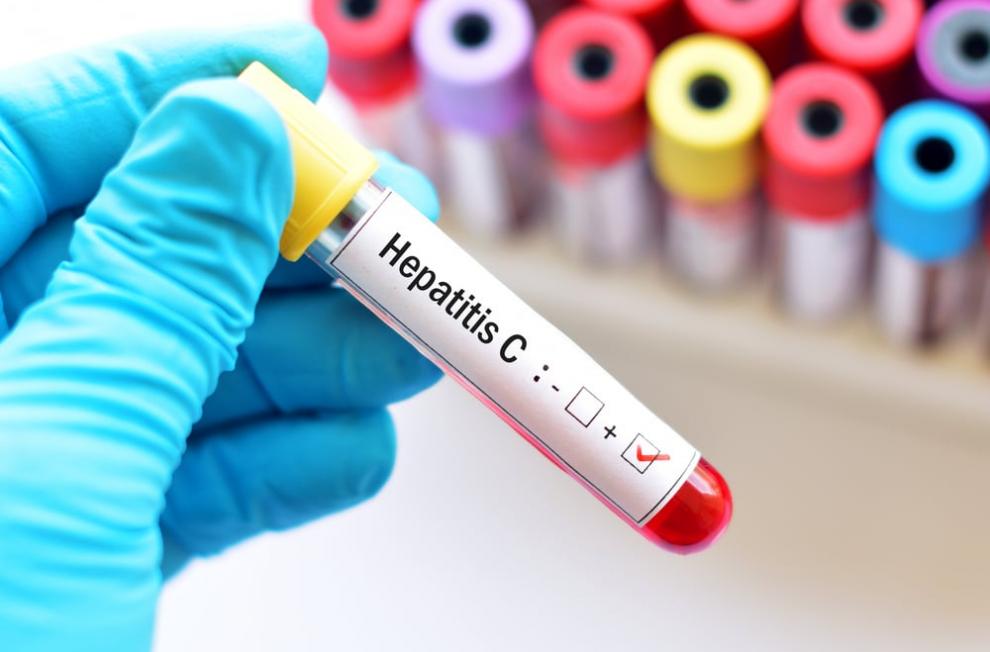 what is hepatitis c symptoms of hepatitis c 4