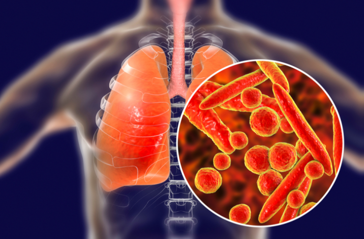 5 causes of pneumonia that you need to recognize 2