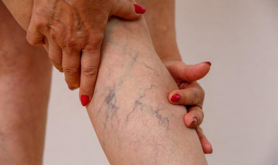 What are the symptoms of varicose veins?