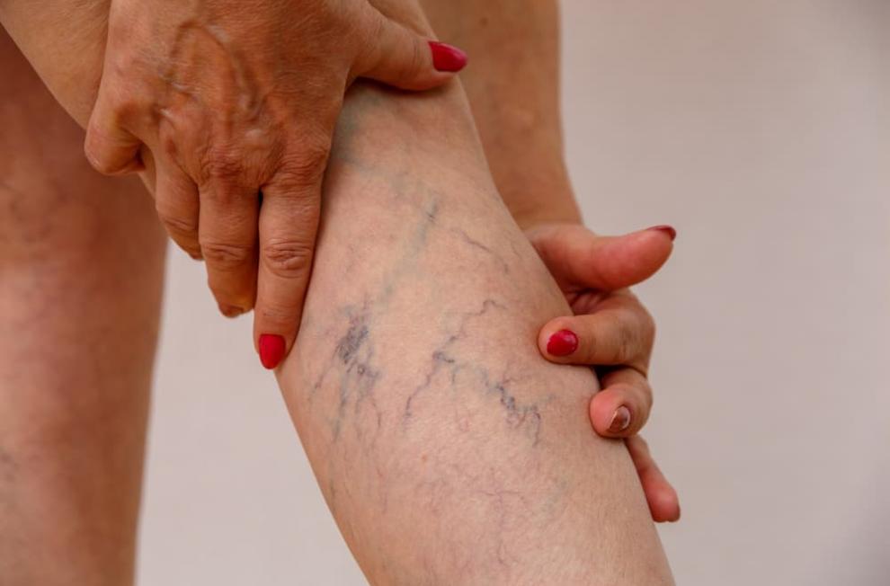 what are the symptoms of varicose veins 1