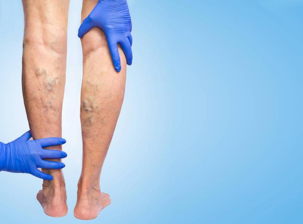 what are the symptoms of varicose veins 3