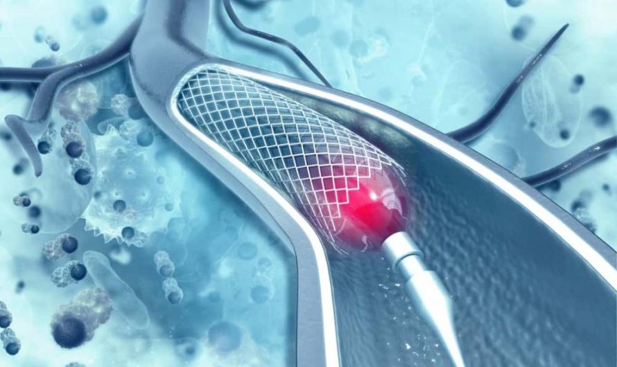 What is a stent? Common procedures and complications