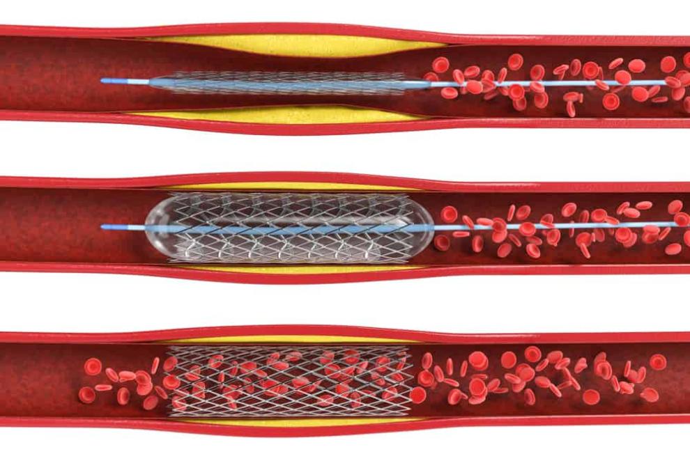 what is a stent common procedures and complications 2