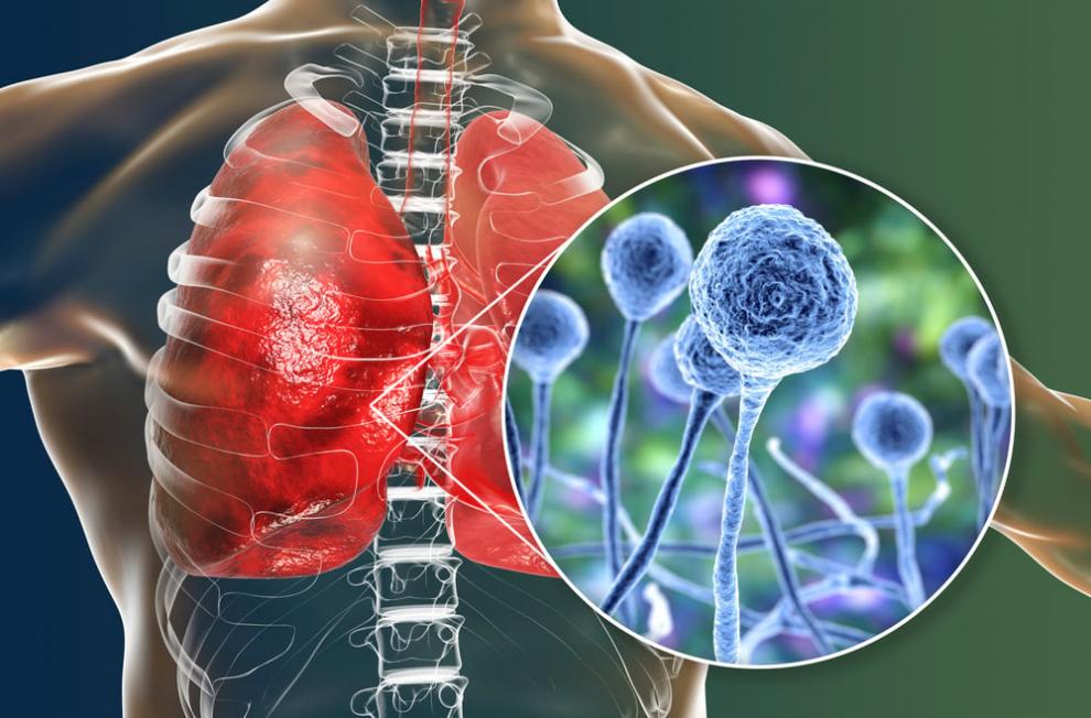 what are the signs and symptoms of fungal pneumonia 3