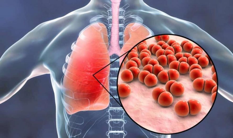 What is pneumococcal pneumonia?