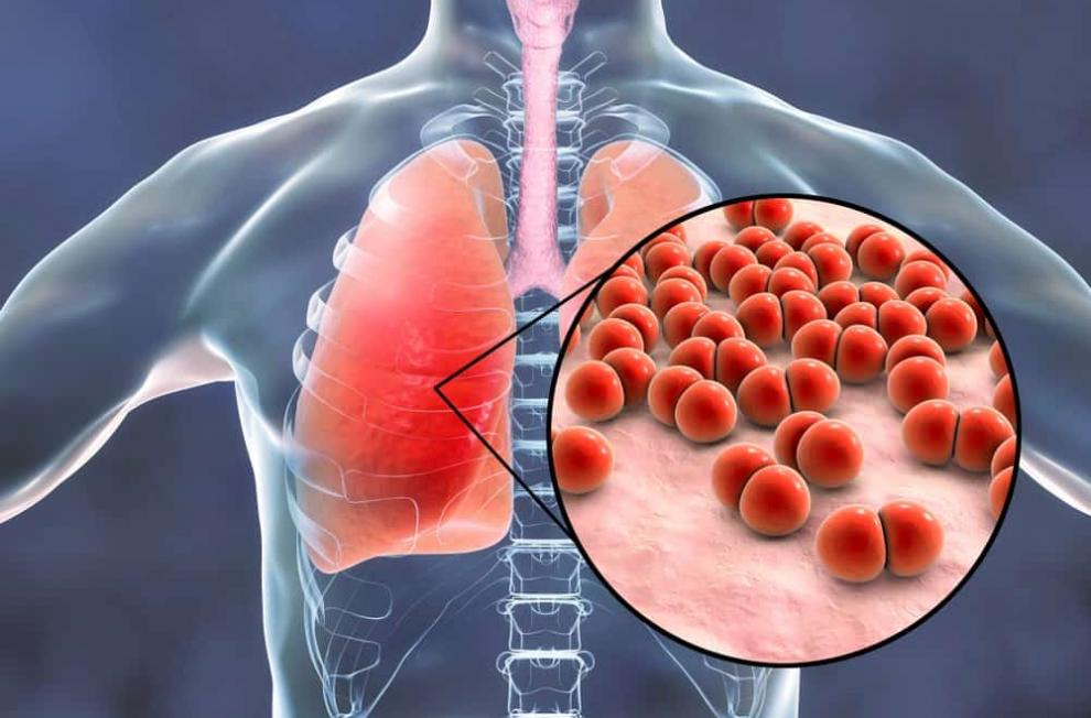 what is pneumococcal pneumonia 1